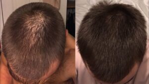Finasteride có tác dụng nhất ở vùng đỉnh đầu