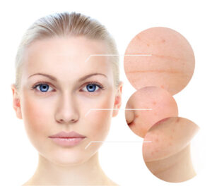 Nám da, đồi mồi, tàn nhang là những biểu hiện của chứng tăng sắc tố da