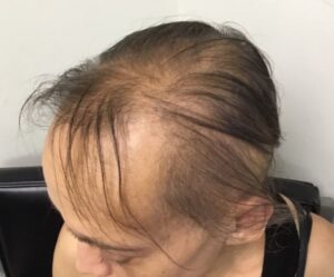 Rụng tóc lan tỏa trên toàn bộ đầu