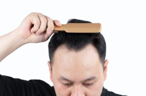 Rụng tóc tiết tố nam còn được gọi là rụng tóc hói đầu
