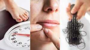 Rụng tóc là một trong số những ảnh hưởng của hội chứng buồng trứng đa nang