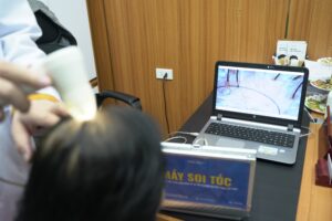 Soi tóc để chẩn đoán nguyên nhân rụng tóc