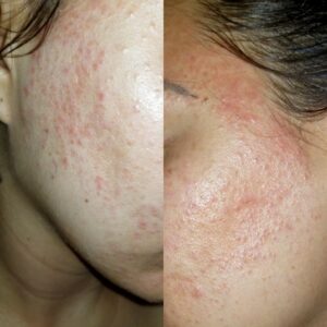 Cần phân biệt da bị kích ứng và dị ứng