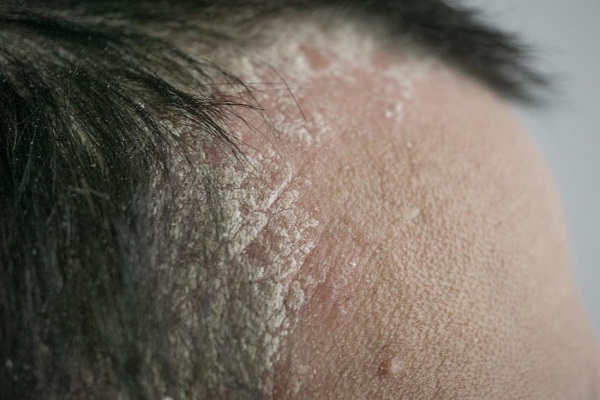 Vẩy nến là một bệnh lý mãn tính khó có thể chữa khỏi triệt để