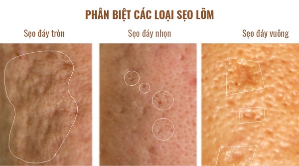 Các loại sẹo lõm do mụn