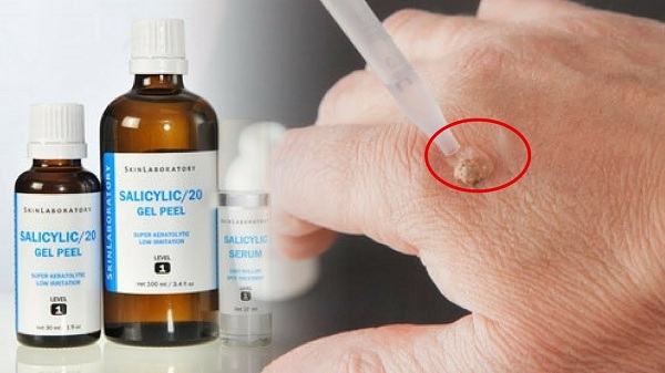 Axit Salicylic là một chấy lột da hóa học phổ biến