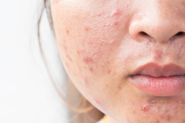 Sẹo khiến mọi người tự ti và có thể gặp nhiều khó khăn trong cuộc sống