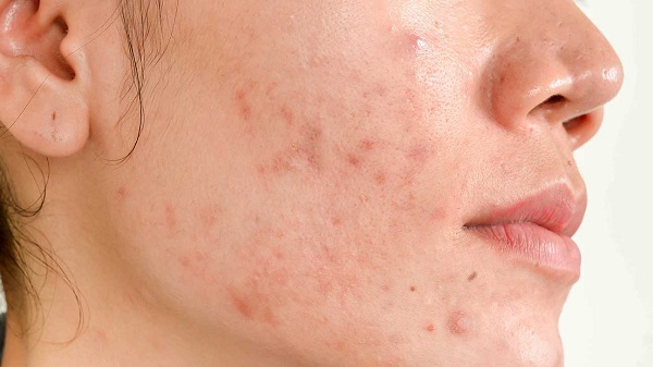 Sẹo thâm có thể được cải thiện nếu sử dụng Axit Kojic