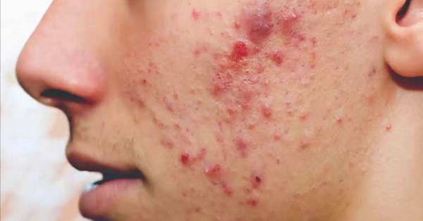 Không nên điều trị nám bằng axit kojic nếu da đang bị tổn thương