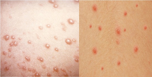 Các nốt thủy đậu