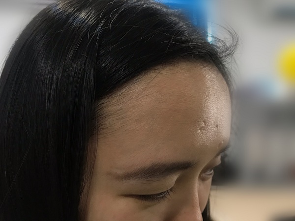 Sẹo lõm hình thành do bệnh thủy đậu