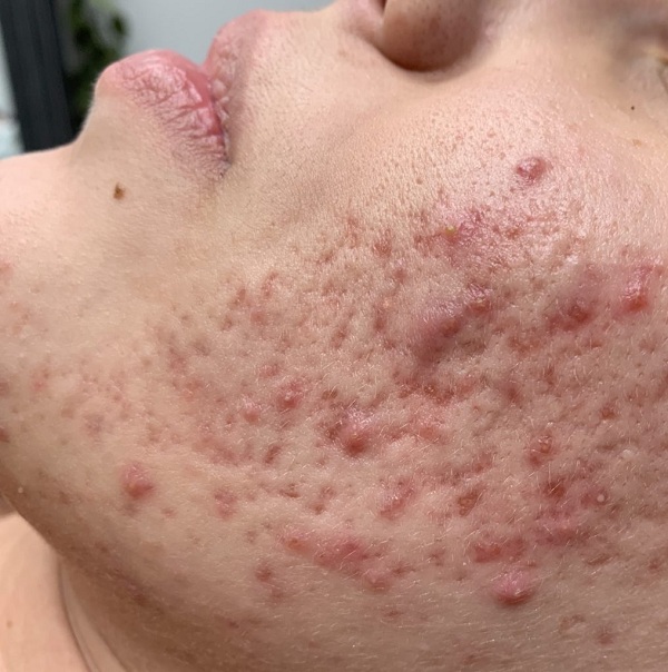 Mụn trứng cá là nguyên nhân chính gây nên sẹo rỗ đáy nhọn