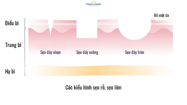 Có 3 kiểu hình sẹo rỗ chính là sẹo đáy nhọn, sẹo đáy vuông và sẹo đáy tròn