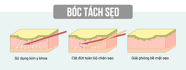 Minh họa quá trình bóc tách đáy sẹo