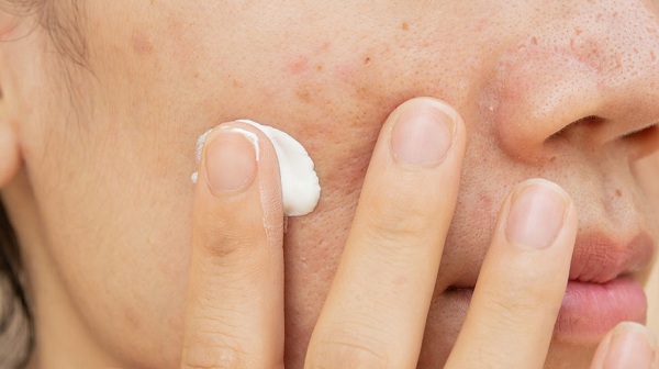 Thuốc bôi là không thể thiếu trong phương pháp điều trị đa trị liệu