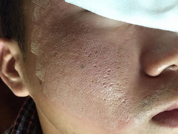 Hình ảnh sau khi điều trị sẹo lõm bằng laser