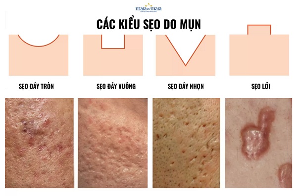 Các kiểu sẹo có thể hình thành sau mụn