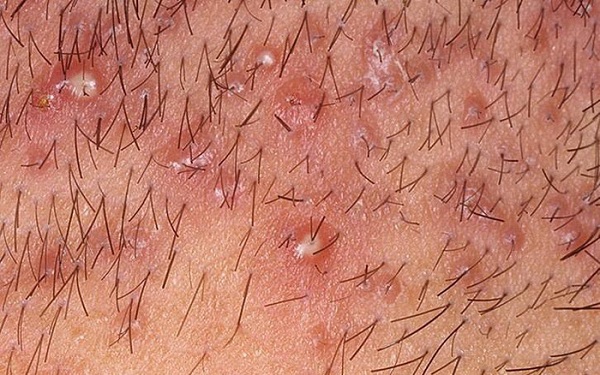 Mụn viêm nang lông da đầu kèm theo mủ