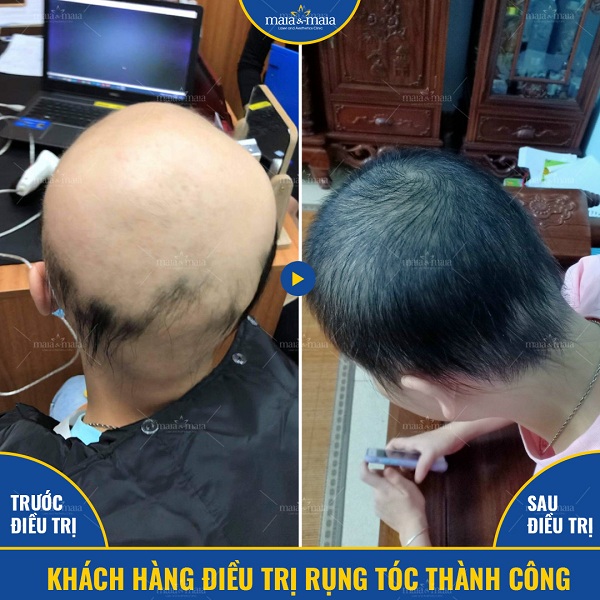 Khách hàng điều trị rụng tóc thành công tại phòng khám Maia