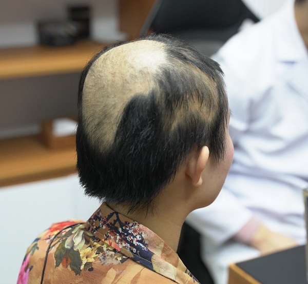 Rụng tóc do nấm da đầu