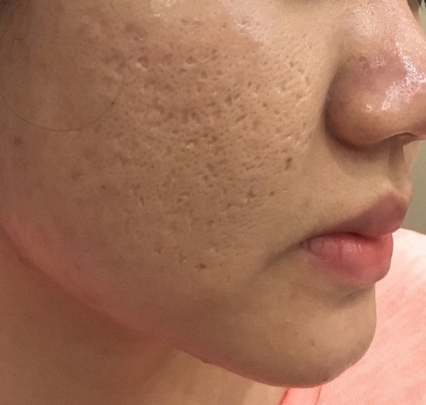 Một người có thể có nhiều loại sẹo rỗ trên mặt