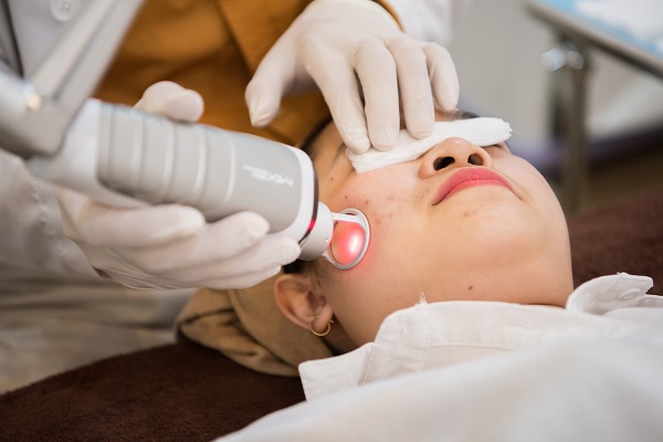 Điều trị sẹo rỗ bằng công nghệ laser