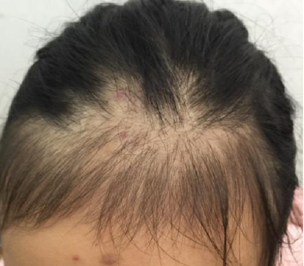 Bạn có thể nhận biết tình trạng rụng tóc ở thanh thiếu niên bằng mắt thường