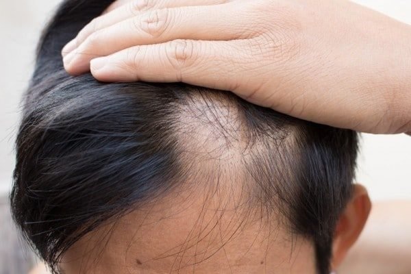 Gội đầu nhiều có thể khiến da đầu bị yếu, dẫn đến rụng tóc