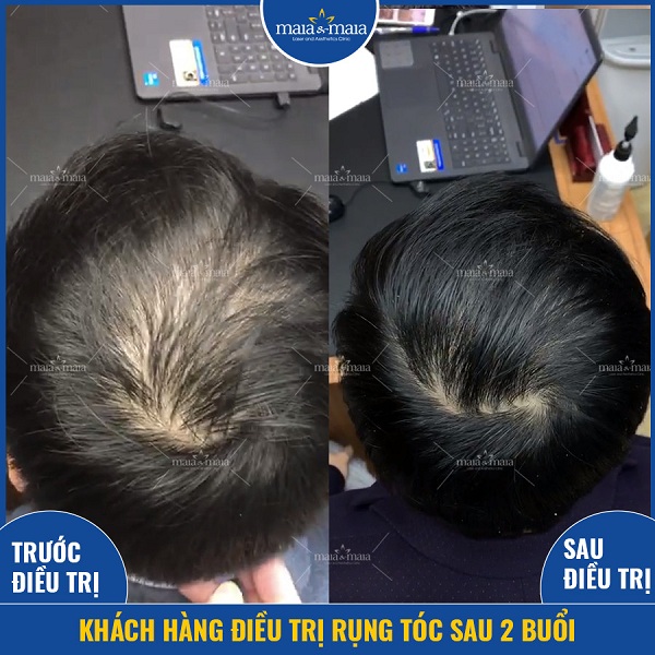 Bệnh rụng tóc vẫn có thể khắc phục được nếu sử dụng đúng phương pháp