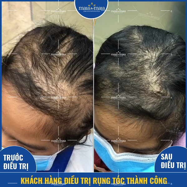 Hỗ trợ điều trị rụng tóc do tật nhổ tóc ở trẻ em