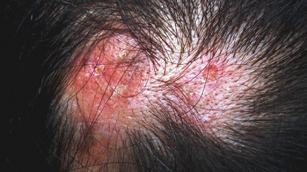 Lupus ban đỏ là bệnh gây rụng tóc sẹo