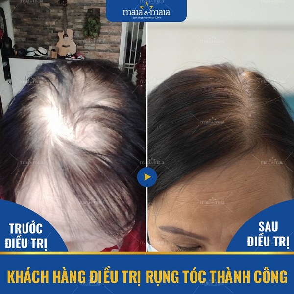 Điều trị rụng tóc do hormone Androgen ở nữ