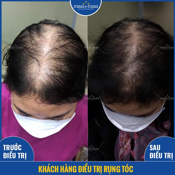 Hiệu quả sau hỗ trợ điều trị sau 5 buổi