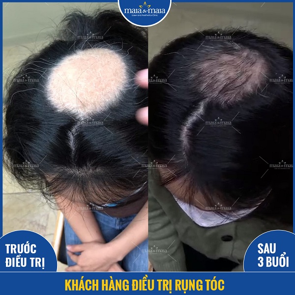 Kết quả sau 3 buổi điều trị