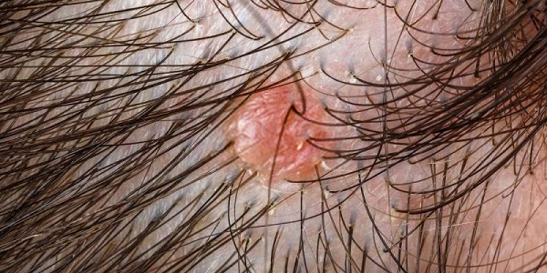 Da đầu và nang tóc bị tổn thương