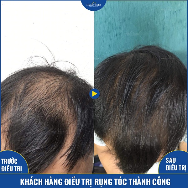 Hiệu quả khi sử dụng phương pháp Meso hỗ trợ kích thích mọc tóc