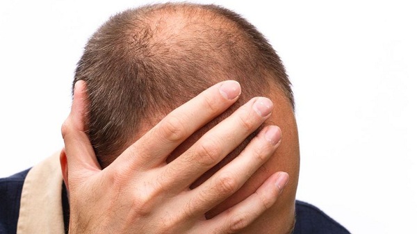 Hầu hết những người xạ trị đều bị rụng tóc
