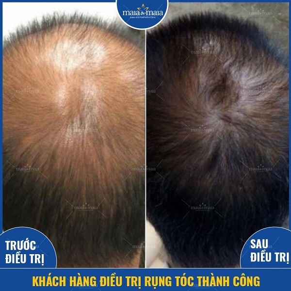 Khách hàng khắc phục rụng tóc ở đỉnh đầu bằng công nghệ Meso