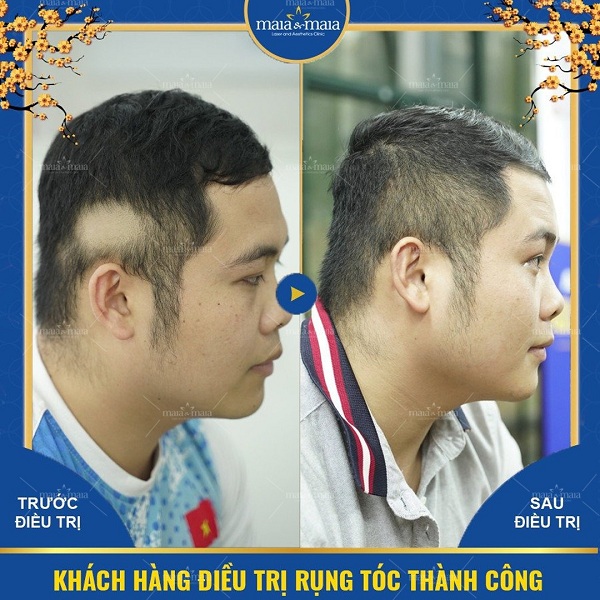 Khách hàng điều trị rụng tóc từng mảng thành công