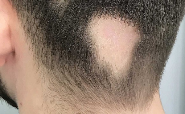 Rụng tóc thành từng mảng do ảnh hưởng của bệnh tự miễn