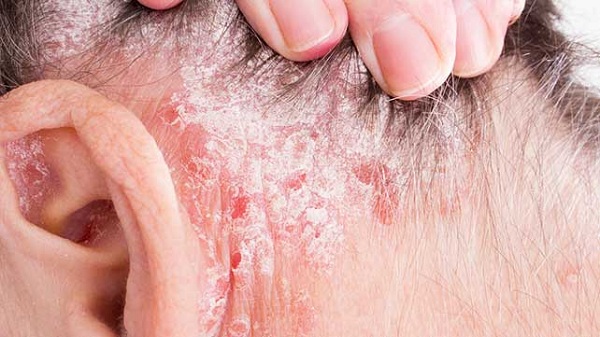 Viêm da tiết bã có biểu hiện bệnh khá tương tự như vảy nến và nấm đầu