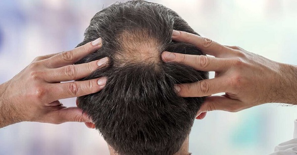Cần tìm hiểu rõ nguyên nhân trước khi điều trị rụng tóc