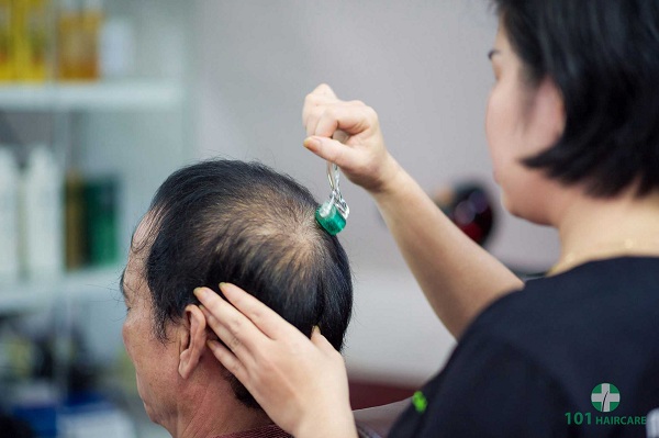 Lăn kim là phương pháp có thể gây đau đớn trong nhiều ngày