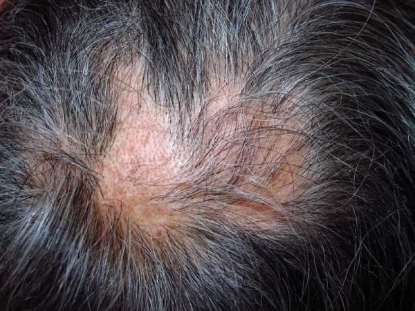 Rụng tóc nhiều có thể là do ảnh hưởng của các bệnh trên da đầu