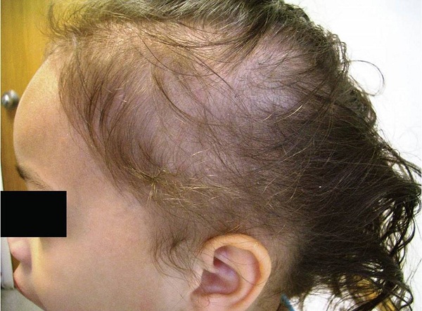 Rụng tóc lan tỏa,tóc yếu và mỏng