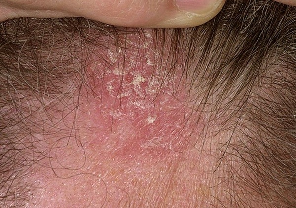 Viêm da trên đầu gây rụng tóc sẹo