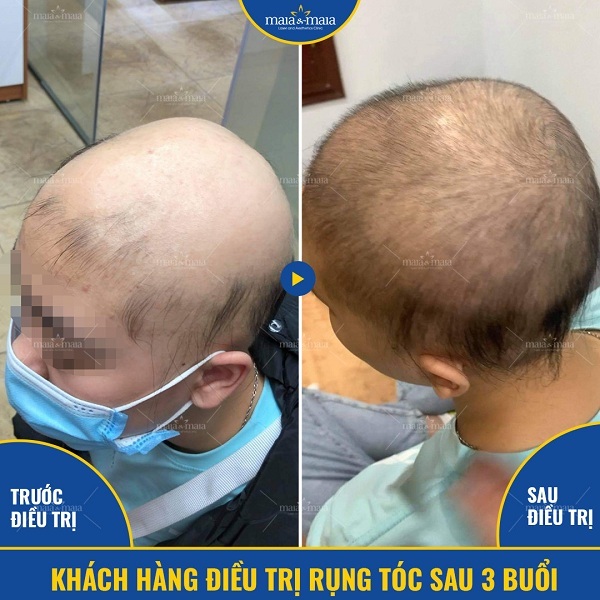 Rụng tóc Telogen có thể khiến tóc rụng toàn bộ