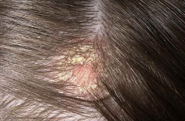 Nấm đầu gây rụng tóc nhiều