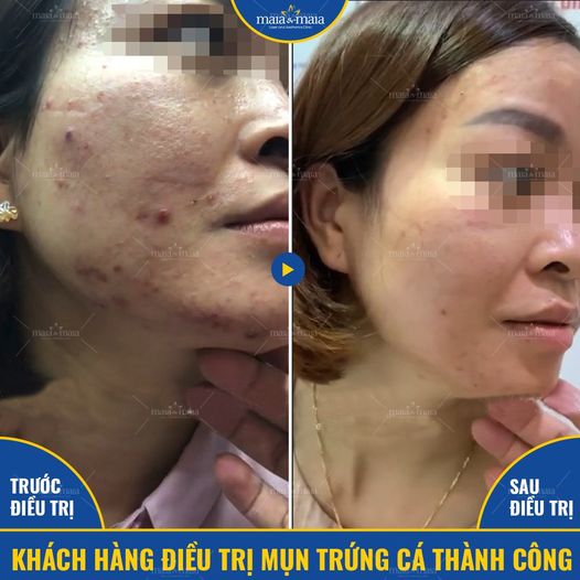Khách hàng Nguyễn Thị Thu khỏi mụn sau 5 buổi Khách hàng Nguyễn Thị Thu khỏi mụn sau 5 buổi