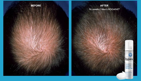 Rogaine kích thích tóc mọc lên dày dặn